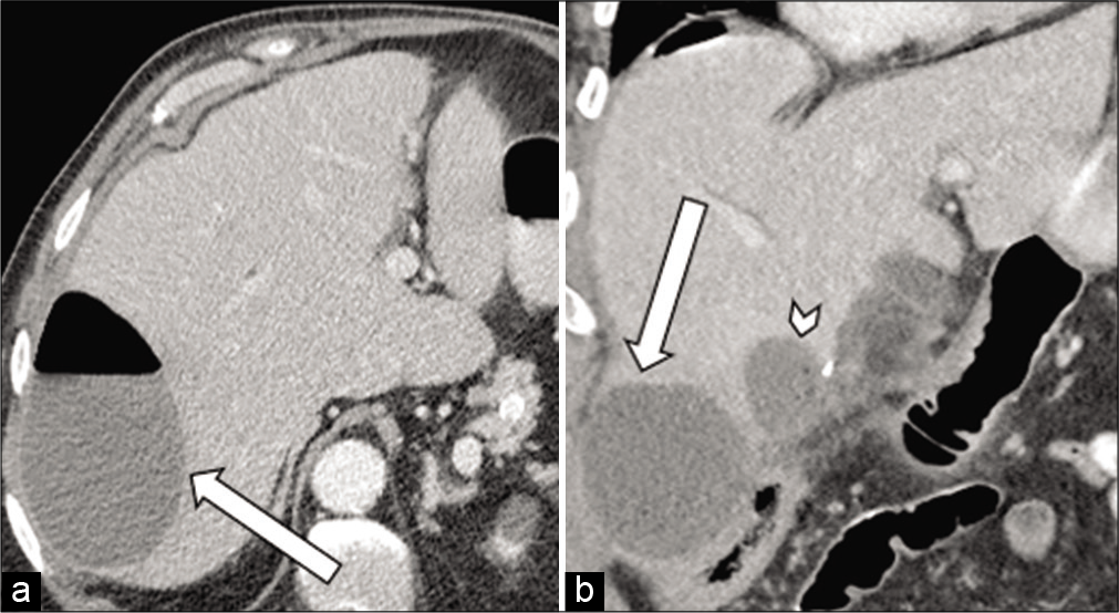 71-year-old male with a recent cholecystectomy who presents with abdominal pain (a) axial contrast-enhanced CT of the abdomen and pelvis demonstrates a large abscess in the right hepatic lobe (arrow). (b) Coronal contrast-enhanced CT of the abdomen and pelvis (right image) demonstrates another large abscess at the base of the right hepatic lobe (arrow) with a medial smaller abscess (arrowhead).