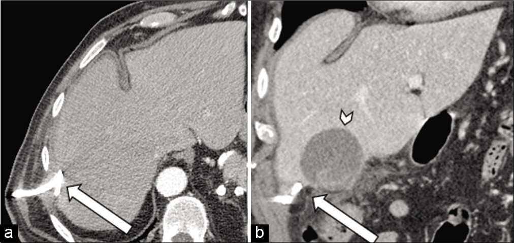 71-year-old male with a recent cholecystectomy complicated by multiple abdominal abscesses who presents with abdominal pain. (a) Axial contrast-enhanced CT of the abdomen and pelvis (left image) demonstrates placement of drainage catheter in the right hepatic lobe abscess (arrow). (b) Coronal contrast- enhanced CT of the abdomen and pelvis (right image) demonstrates a drainage catheter in the inferior hepatic abscess (arrow) with interval growth of the more medial abscess (arrowhead).