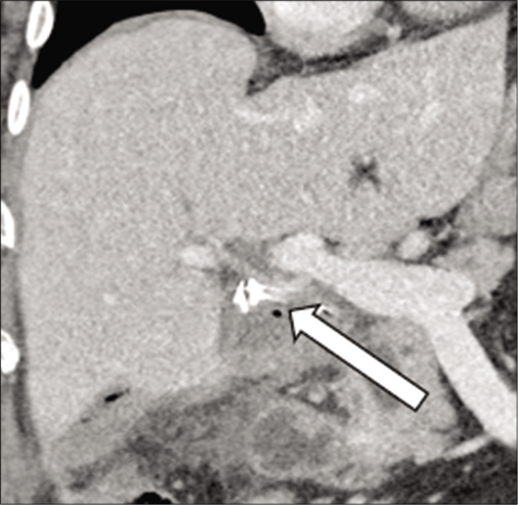 71-year-old male with a recent cholecystectomy complicated by multiple abdominal abscesses who presents with abdominal pain. Coronal contrast-enhanced CT of the Abdomen and pelvis demonstrates a subtle aneurysmal dilatation of the proper hepatic artery (arrow) concerning for a mycotic aneurysm.