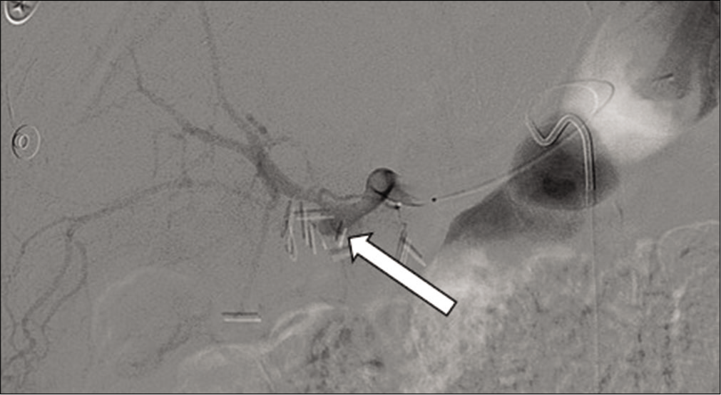 71 year old male with a recent cholecystectomy complicated by multiple abdominal abscesses who presents with worsening abdominal pain. Angiogram of the hepatic artery demonstrating an aneurysm at the distal hepatic artery (arrow) with no evidence of active bleeding.