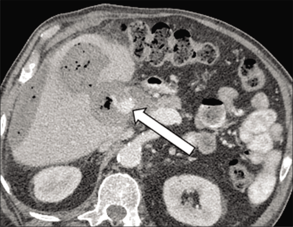 71 year old male with a known mycotic pseudoaneurysm of the hepatic artery presents with worsening abdominal pain. Axial contrast-enhanced image of the abdomen demonstrates interval growth of the mycotic aneurysm (arrow).