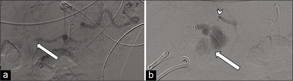 71-year-old male with a known mycotic pseudoaneurysm of the hepatic artery who recently coded on multiple vasopressors. (a) Angiogram at the celiac artery demonstrates no distal flow to the hepatic artery with large active hemorrhage (arrow). (b) Microcatheter was advanced to the distal hepatic artery (arrowhead), with angiogram demonstrating massive active hemorrhage (arrow).