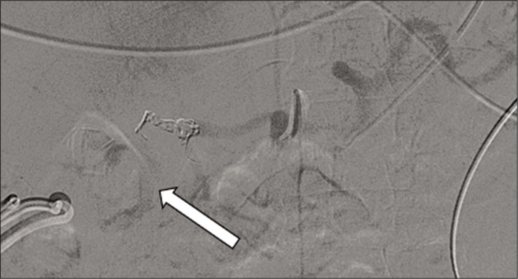 71-year-old male with a known mycotic pseudoaneurysm of the hepatic artery who recently coded on multiple vasopressors. Angiogram demonstrating multiple coils deployed into the gastroduodenal and proximal proper hepatic artery. Despite the placement of the coils, there is still active contrast extravasation from the aneurysm (arrow).