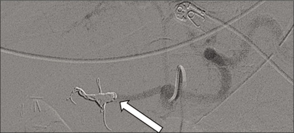 71-year-old male with a known mycotic pseudoaneurysm of the hepatic artery who recently coded on multiple vasopressors. After the direct administration of thrombin through the catheter, an angiogram of the celiac artery demonstrates successful embolization and no further extravasation (arrow).