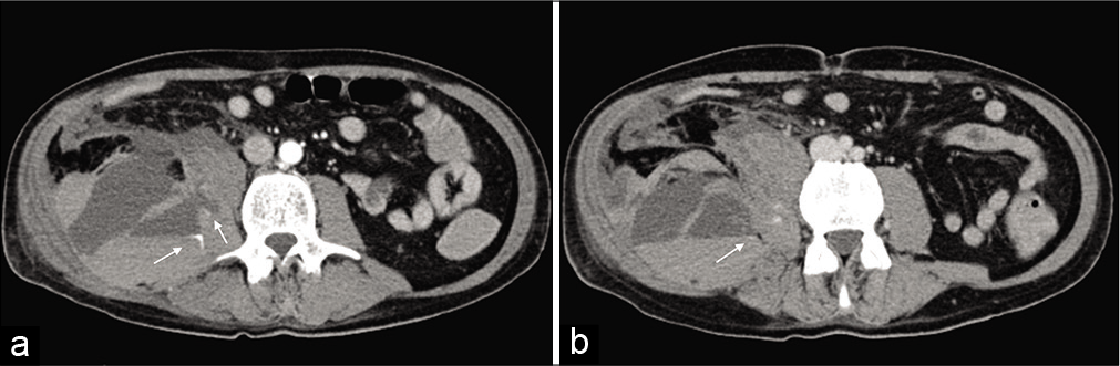 Axial view of the CT angiogram showing a spontaneous heterogeneous 18.7 × 8.8 × 10.8 cm right iliopsoas hematoma with two areas of active arterial bleeding (white arrows) (a and b), possibly originating from the ipsilateral lumbar artery.