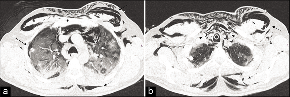 Non-contrast computer tomography was carried out showing a massive subcutaneous emphysema (dashed black arrows), extending from the thoracic outlet and the axillae to the laterocervical areas, surrounding the rhomboids muscles posteriorly. It also demonstrated compressive pneumomediastinum (black arrow heads), located predominantly in the anterior and superior mediastinum, and a right pneumothorax (black arrows), located in the anterolateral region of the apical segment of the right superior lobe (a and b).