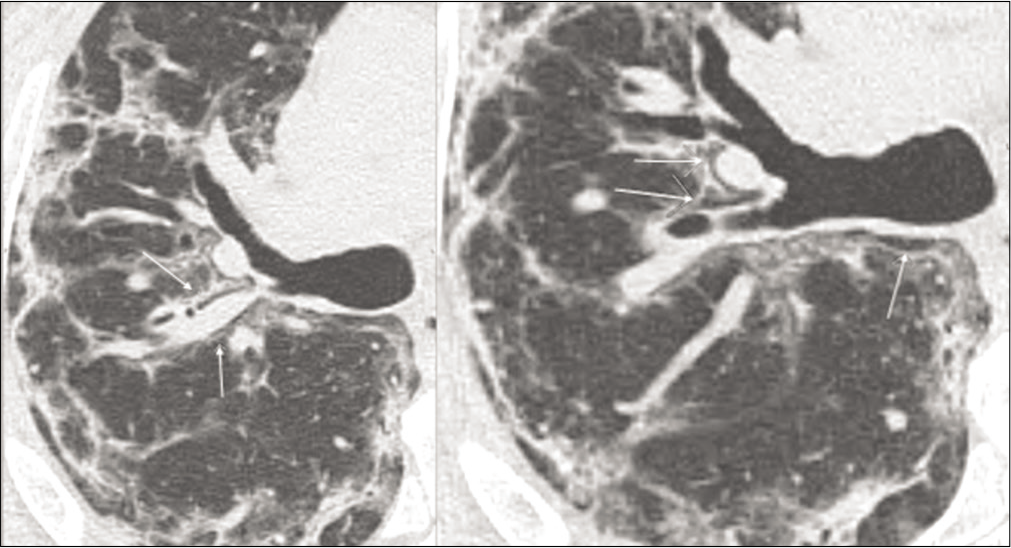 Axial view of a non contrast CT scan showing progressive pneumomediastinum (white arrows). This completely resolved after CPAP suspension.