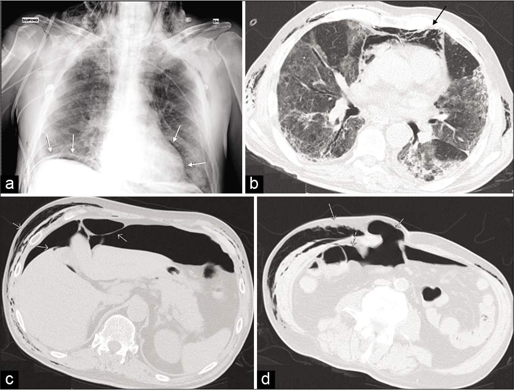 Bedside Chest-XR showing a massive subcutaneous emphysema and a small quantity of subphrenic air (a) (white arrows). Axial view of CT-scan demonstrating an extensive compressive pneumomediastinum (black arrow) (b) and pneumoperitoneum located predominantly under the anterior wall, around the liver and spleen (c and d).