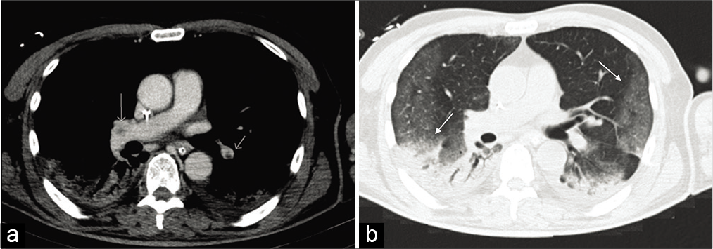 A contrast-enhanced CT of the chest was undertaken, confirming multiple filling defects of the middle lobar artery on both sides (a) indicating acute pulmonary embolism (white arrows). Axial view of CT scan showing with lung window bilateral peripheral ground glass opacities and consolidations in the inferior lobes (b) (black arrows).