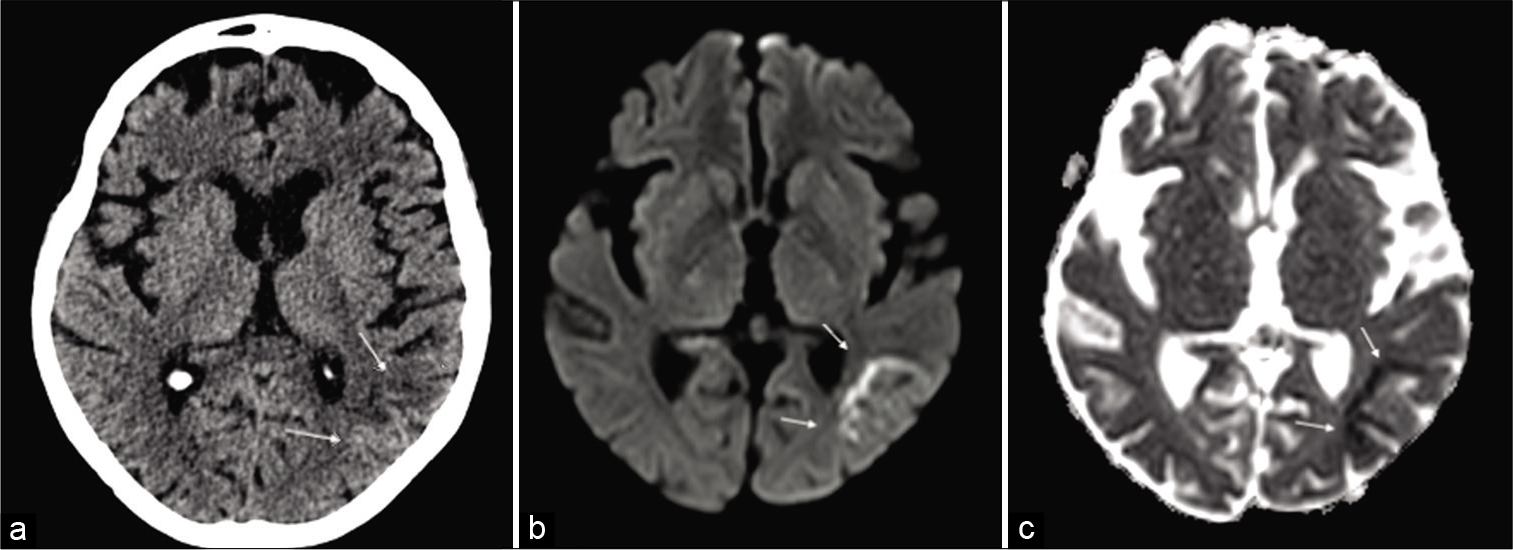 A brain CT and then magnetic resonance imaging scan were undertaken to rule out acute ischemic stroke or viral encephalitis. The axial CT scans showed mild parietal subcortical hypodensity (a) confirmed on the subsequent MRI (b and c) scan, showing multiple linear areas of subcortical restricted diffusion (DWI) in the same territory and hypointensity on correspondent ADC maps (b and c) (white arrows). An acute ischemic stroke was diagnosed.