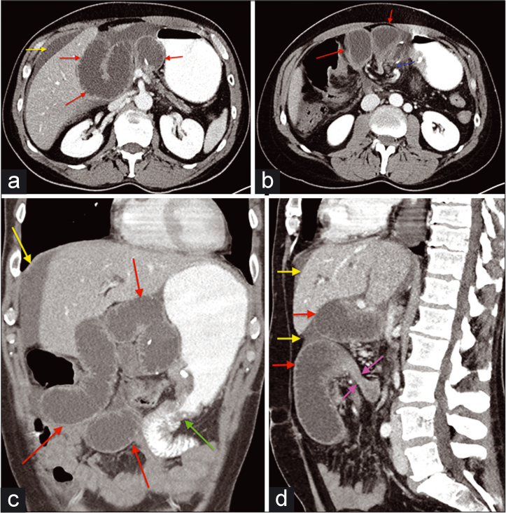 A 40-year-old male presented with jaundice, dark urine, pruritus, and a 20 lb unintended weight loss. The patient underwent a Whipple procedure for pancreatic cancer, recovered well, and presented 6 weeks later with moderate-severe pain, nausea, vomiting, and repetitive dry heaving. (a and b) Axial CT images with IV and oral contrast demonstrate dilation of the afferent loop (red arrow). Free intra-abdominal fluid is present (yellow arrow). There is twisting of the mesentery with poor opacification of the superior mesenteric vein (blue arrow) (c) Coronal CT image demonstrate dilation of the afferent loop (red arrow). Free fluid is again demonstrated (yellow arrow). The distal small bowel is normal. The gastrojejunostomy site is visualized (green arrow). (d) Sagittal CT image with IV and oral contrast demonstrates a transition point within the afferent loop distally (purple arrows). Dilation of the more proximal afferent loop is again seen (red arrow). Free fluid is present (yellow arrows).