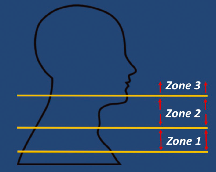 Modified three zone classification for penetrating trauma. Zone 1: Clavicles/sternum to the cricoid cartilage. Zone 2: Cricoid cartilage to the angle of the mandible. Zone 3: Angle of the mandible to the skull base.