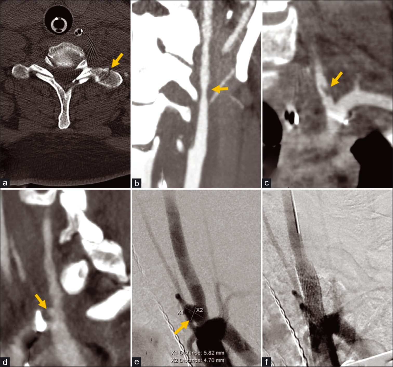 A 31-year-old female with cervical spine fracture from motor vehicle collision. (a) Non-contrast axial CT image of the cervical spine demonstrates a non-displaced fracture of the left C7 transverse process (arrow). (b) CTA coronal MIP images of the neck demonstrates Grade 2 dissection with >25% stenosis in the mid let cervical ICA (arrow), and (c) Grade 2 dissection with raised intimal flap in the V1 segment of the left vertebral artery (arrow). Follow-up CTA of the neck demonstrated healing resolution of the left ICA dissection, but the left vertebral artery dissection (d) progressed to a pseudoaneurysm/Grade 3 injury (arrow). (e) Conventional angiography of the neck demonstrated further increase in the size of the pseudoaneurysm (arrow). (f) A 6 × 20 mm Precise Pro Carotid Stent (Cordis, Santa Clara, California, USA) was deployed across the dissection with subsequent injection demonstrating successful embolization of the pseudoaneurysm.