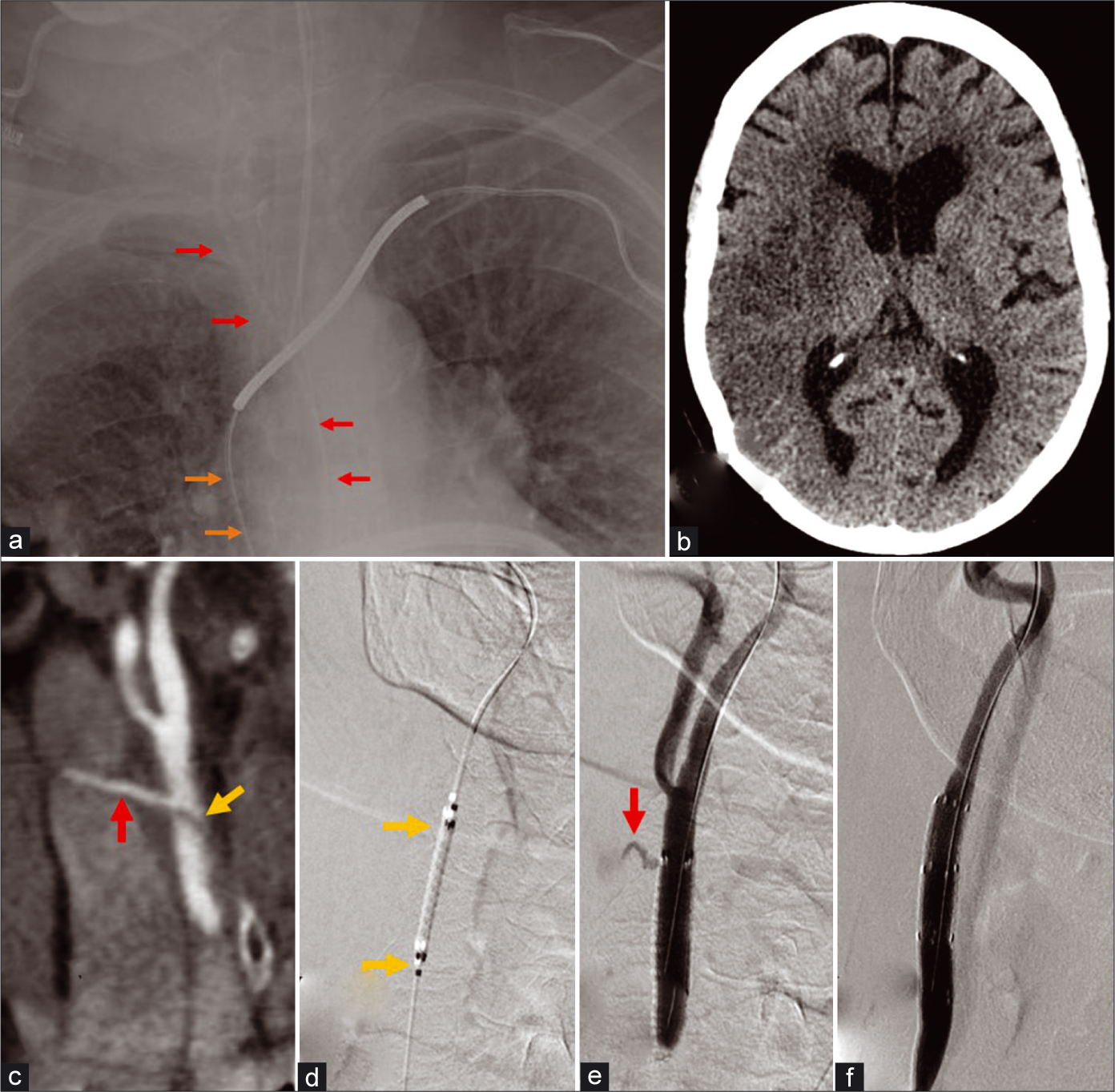 A 66-year-old female transferred from an outside hospital with arterial placement of right central venous line and left side weakness. (a) AP chest radiograph demonstrates incorrect arterial placement of an intended right internal jugular catheter (red arrows); the left subclavian approach pacemaker lead reveals the true course of the superior vena cava (orange arrows). (b) Non-contrast head CT demonstrates an evolving acute infarct in the right MCA territory from embolic occlusion of the right MCA M1 segment. (c) CTA coronal MIP image of the neck demonstrates a dissection flap in the right common carotid artery (yellow arrow) and discrete tract (yellow arrow) from the removed catheter connecting the right CCA to the right internal jugular vein consistent with an arteriovenous fistula. (d) Conventional angiography pre-contrast image demonstrates initial pre-deployment position of a 6 × 25 mm Viabahn covered stent (yellow arrows) in the right CCA across the site of fistula. (e) Right CCA injection image after angioplasty with 7 × 20 mm Aviator balloon demonstrates proximal migration of the stent and persistent fistula with filling of the right IJV (red arrow). (f) A second Viabahn stent was placed more distally in the CCA and injection image after the angioplasty demonstrates obliteration of the fistula.