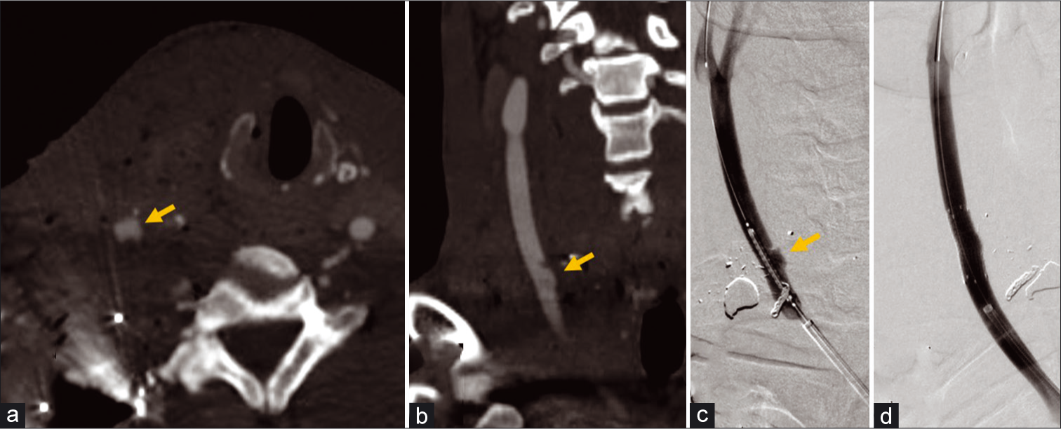 A 34-year-old male with gunshot to the right side of the neck. (a and b) Axial and coronal CTA MIP images of the neck demonstrate contour irregularity and a vascular outpouching representing pseudoaneurysm (arrows) at the medial aspect of the right common carotid artery. (c) Conventional angiography of the neck provides better resolution of the pseudoaneurysm (arrow). (d) An 8 × 25 mm Viabahn covered stent was placed with successful exclusion and no residual filling of the pseudoaneurysm.