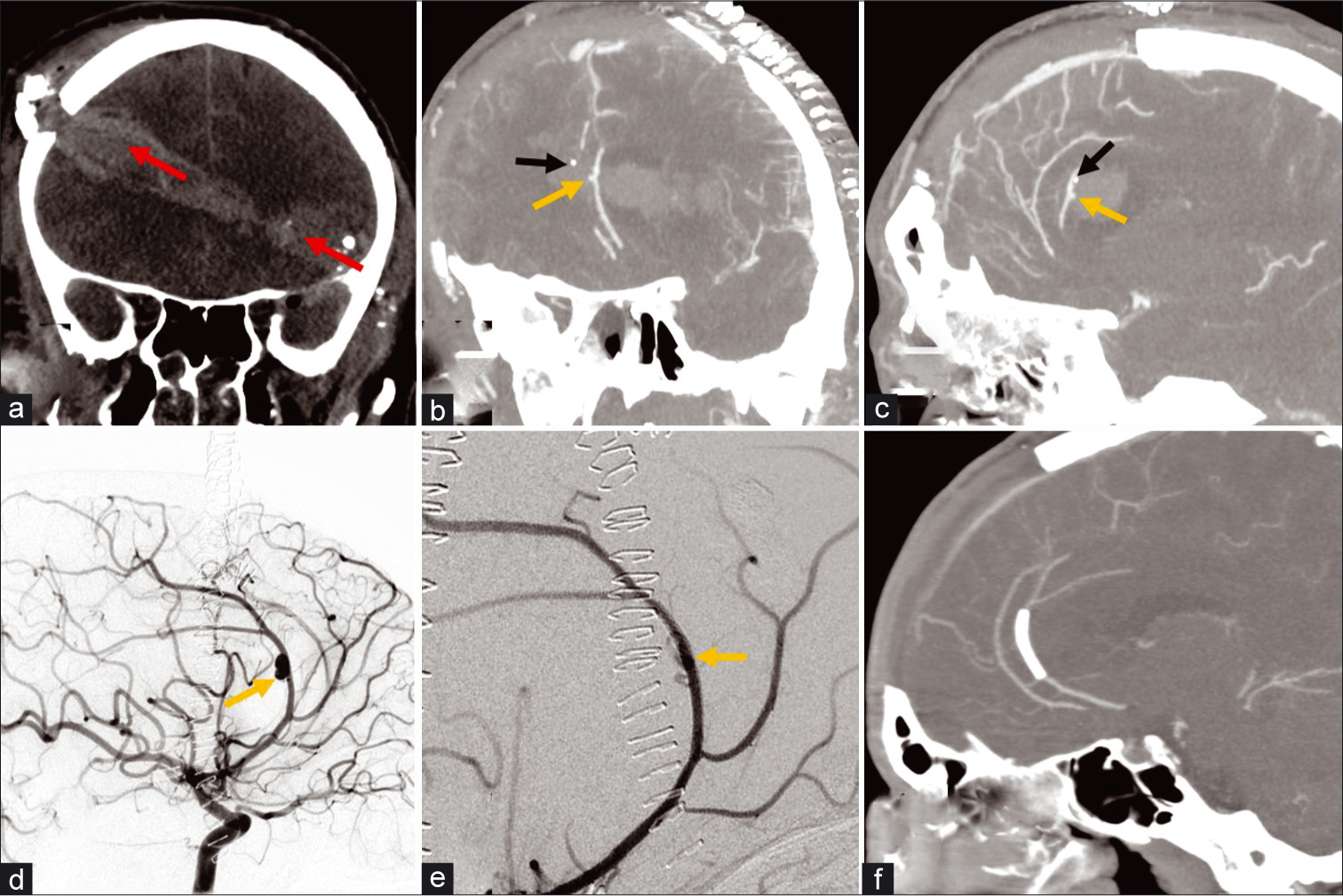 A 32-year-old male with self-inflicted gunshot wound to the head. (a) Non-contrast CT coronal MIP demonstrates a bullet trajectory from the left temporal aspect through the right frontal region with a hematoma along trajectory (red arrows) and blowout fracture wound on the right. (b and c) CTA coronal and sagittal MIP images of the head obtained after a decompressive craniectomy demonstrate a contrast outpouching (yellow arrow) from the left pericallosal artery or left ACA A3 segment consistent with an pseudoaneurysm; a punctate hyperdense focus nearby (black arrow) with attenuation greater than contrast represents bone debris confirmed with presence on the non-contrast images. (d) Conventional angiography lateral projection of the left ICA injection demonstrates increased size of the ACA aneurysm (arrow). (e) The pseudoaneurysm was treated using flow diversion with a pipeline embolization device and subsequent injection demonstrated slowed filling and contrast stagnation within the pseudoaneurysm (arrow) and preservation of parent vessel. (f) Follow-up CTA sagittal MIP image of the head demonstrates successful occlusion of pseudoaneurysm and preserved flow in the ACA.