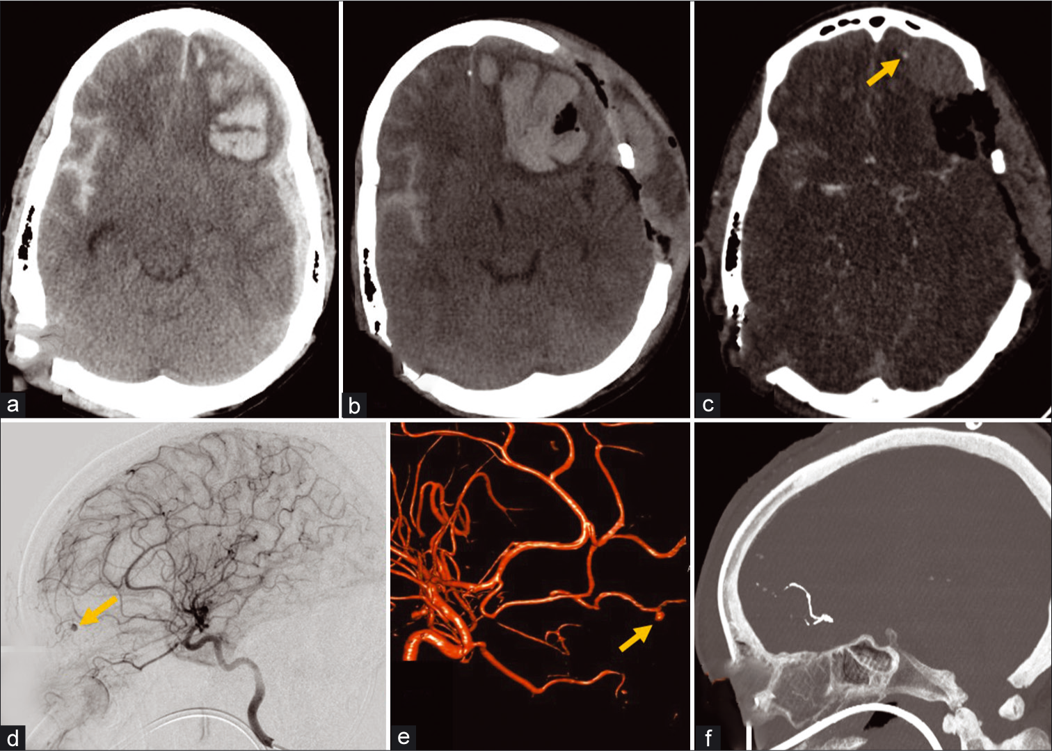 A 52-year-old male with blunt head injury after a ground level fall. (a) Initial non-contrast CT demonstrates left frontal intra- axial hematoma, left hemispheric subdural hematoma, and right subarachnoid hemorrhage. (b) Follow-up non-contrast CT examination after decompressive craniectomy demonstrates enlargement of the left frontal intra-axial hematoma. (c) CTA of the head demonstrates a punctate focus of contrast enhancement at the anterior periphery of the left frontal hematoma likely representing either active contrast extravasation or pseudoaneurysm (arrow). (d) Conventional angiography lateral projection of the left ICA injection and reconstructed 3D rotational angiography image (e) demonstrate the CTA finding to represent a left ACA frontopolar branch pseudoaneurysm (arrows). (f) Post-procedure CTA sagittal MIP image of the head shows hyperdense Onyx material used to embolize the parent frontopolar branch vessel with no residual filling of the pseudoaneurysm.