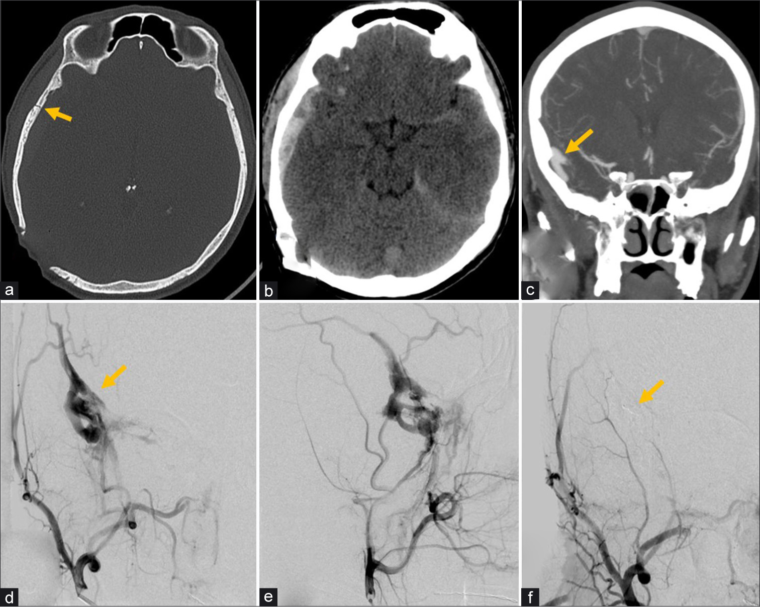 A 39-year-old male with head injury from motor vehicle collision. (a) Non-contrast CT bone window image of the head demonstrates a non-displaced fracture (arrow) of the right temporal calvarium. (b) CT brain window image of the head demonstrates a right temporal extra-axial hematoma deep to the fracture, left cisternal subarachnoid hemorrhage, and left tentorial subdural hemorrhage. (c) CTA coronal MIP image of the head demonstrates tubular vessel-like enhancement in the right temporal extra-axial space concerning for arteriovenous fistula (arrow). (d and e) Conventional angiography selective right internal maxillary artery injection AP (d) and lateral projections (e) confirm middle meningeal arteriovenous fistula (arrow) with associated prominent early venous drainage. (f) AP view right external carotid artery injection demonstrates Onyx embolization (arrow) of the middle meningeal artery with occlusion of the fistula.