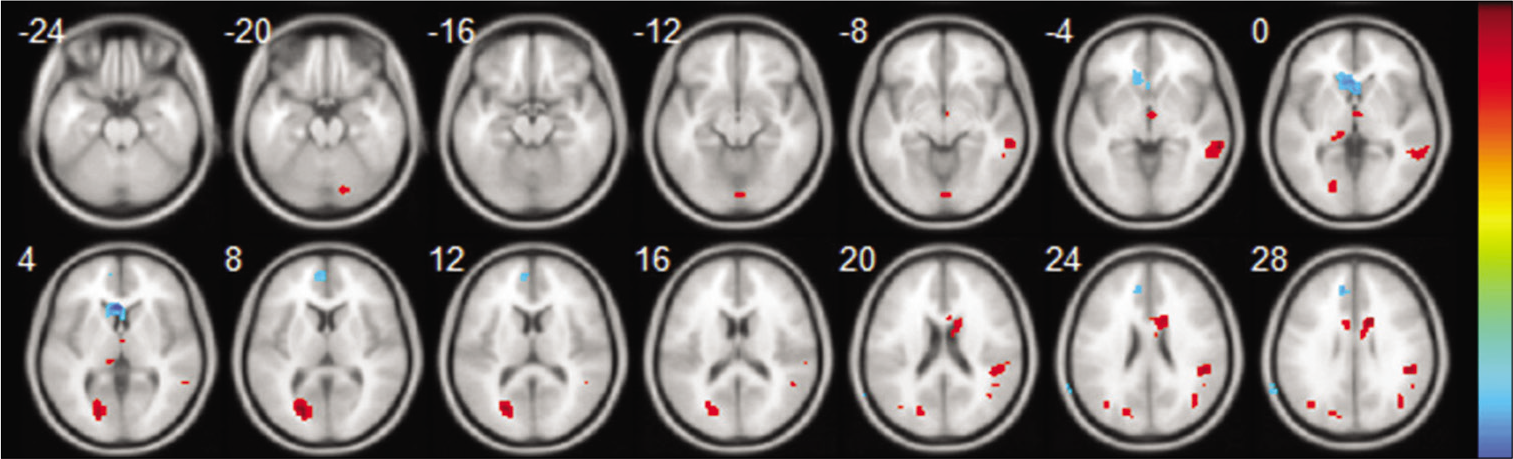 Axial structural image of the brain showing result of amplitude of low-frequency fluctuation (resting-state functional magnetic resonance imaging), Statistic t-map with the difference between the cognitive impairment-temporal lobe epilepsy (CI-TLE) group and CNI-TLE (two-sample t-test, P < 0.01, voxel>10). Warm colors indicate CI-TLE >cognitive not impairment-temporal lobe epilepsy (CNI-TLE), while cool colors indicate CNI-TLE >CI-TLE.