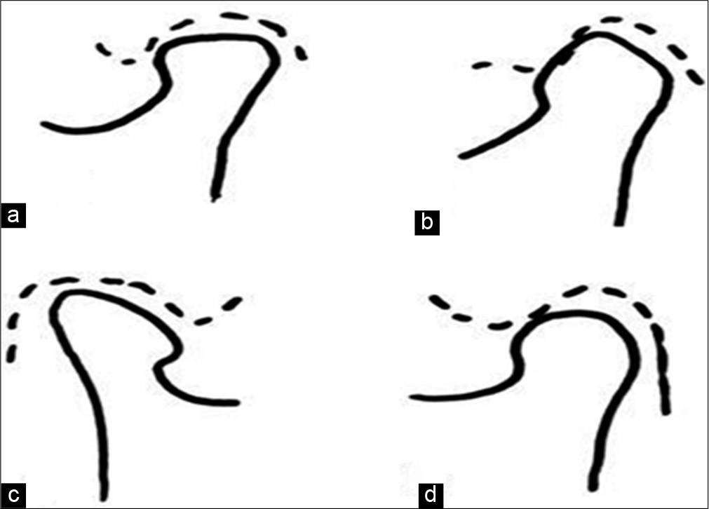 Examples of condyle outlines grouped, according to the shape as: (a) Flat, (b) pointed, (c) angled, and (d) round.[9]