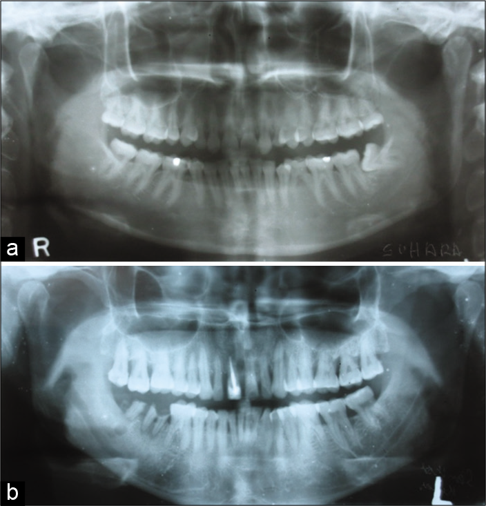(a and b) Panoramic view shows bilaterally round shaped condyles with Eichner Class A (e.g., Figure 1a and 2d).
