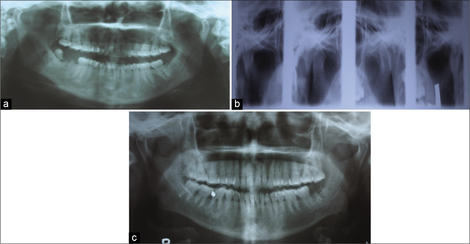 (a) Panoramic view shows bilaterally flat shaped of condyles with Eichner Class A (e.g., Figure 1a and 2a). (b) Double temporomandibular joint view showing flat-shaped condyles (e.g., Figure 2a). (c) Panoramic view shows bilaterally flat-shaped condyles with Eichner Class A (e.g., Figure 1a and 2a).