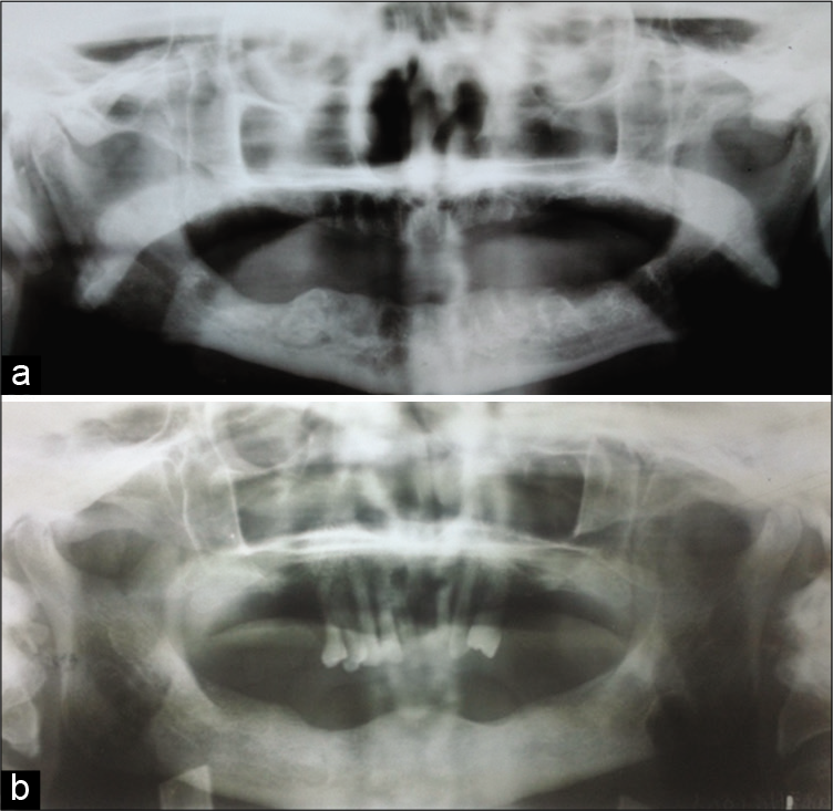 (a) Panoramic view shows bilaterally pointed shaped condyles with Eichner Class C (e.g., Figure 1c and 2b). (b) Panoramic view shows bilaterally round-shaped condyles with Eichner Class C (e.g., Figure 1c and 2d).