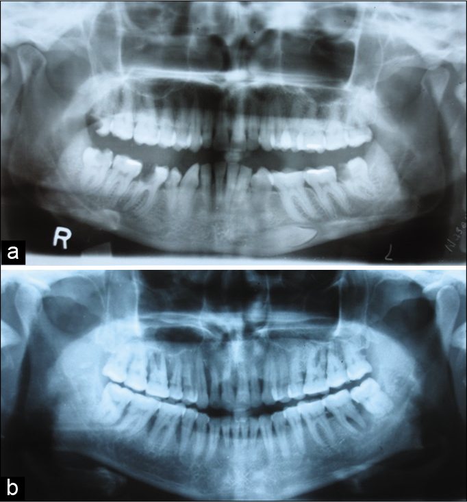 (a) Panoramic view shows angled shaped right and round- shaped left side condyle with Eichner Class A (e.g., Figure 1a and 2c and d). (b) Panoramic view shows pointed shaped right and round-shaped left side condyle with Eichner Class A (e.g., Figure 1a and 2b and d).