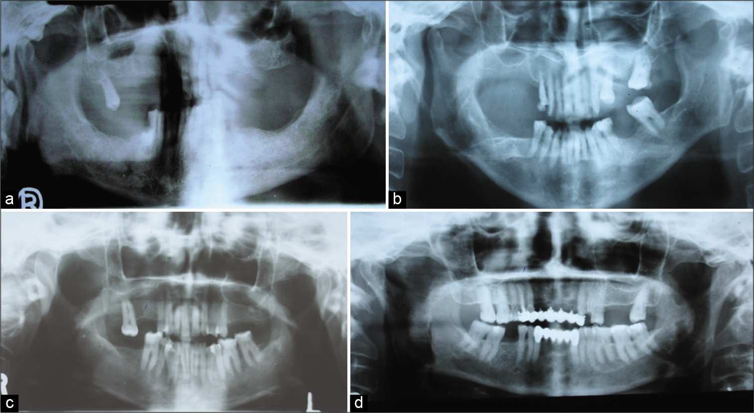 (a) Panoramic view shows round-shaped right and pointed shaped left side condyle Eichner Class B (e.g., Figure 1b and 2d and b). (b) Panoramic view shows pointed shaped right and angled shaped left side condyle Eichner Class B (e.g., Figure 1b and 2b and c). (c) Panoramic view shows flat-shaped right and pointed shaped left side condyle Eichner Class B (e.g., Figure 1b and 2a and c). (d) Panoramic view shows angled shaped right and round-shaped left side condyle Eichner Class B (e.g., Figure 1b and 2c and d).