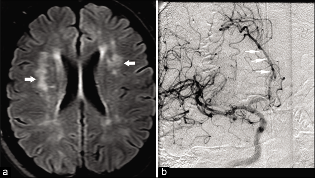 A 39-year-old female patient with CNS vasculitis presented with multiple transient ischemic attacks. (a) Axial FLAIR image shows multiple hyperintensities (arrows) in the cerebral white matter bilaterally. (b) Conventional angiogram of the brain shows multiple segmental narrowing of ACAs (arrows).