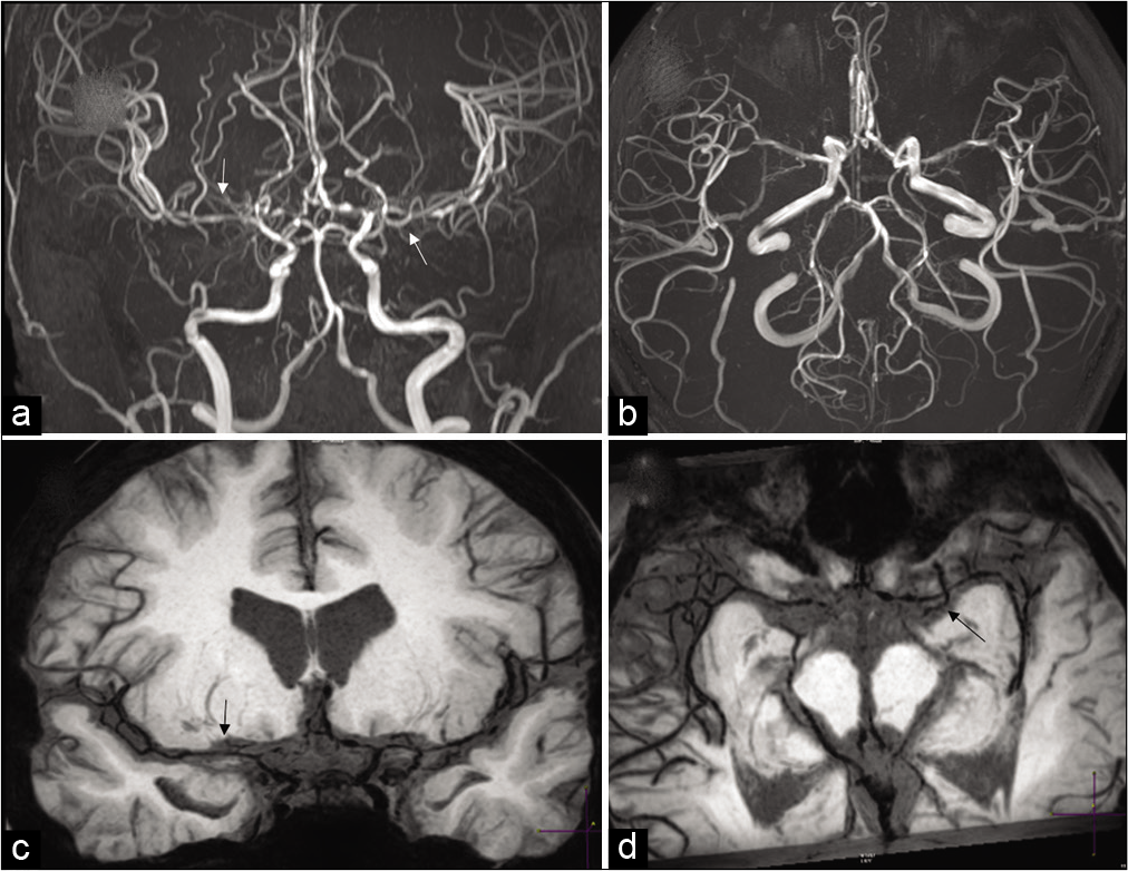 Reversible cerebral vasoconstriction syndrome (RCVS). A 32-year-old female patient with non-aneurysmal pattern subarachnoid hemorrhage on CT. (a and b) Routine MR angiogram images moderate multifocal narrowing of bilateral ACAs, MCAs with beaded appearance of distal cortical branches (arrows). (c and d) High-resolution vessel wall imaging better delineates the segmental vasoconstriction seen on MRA (arrows). There was complete resolution of narrowing on the follow-up MRA done 2 months later (not shown here).