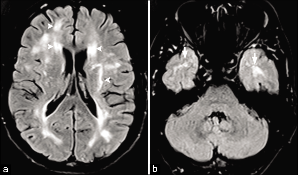 CADASIL in a 43-year-old male patient with a history of migraine and multiple transient ischemic attacks. (a) Axial FLAIR images shows patchy hyperintensities (arrowheads) scattered throughout the supratentorial white matter bilaterally. (b) Axial FLAIR image shows classical hyperintensities in the anterior aspect of the temporal lobes (arrows).