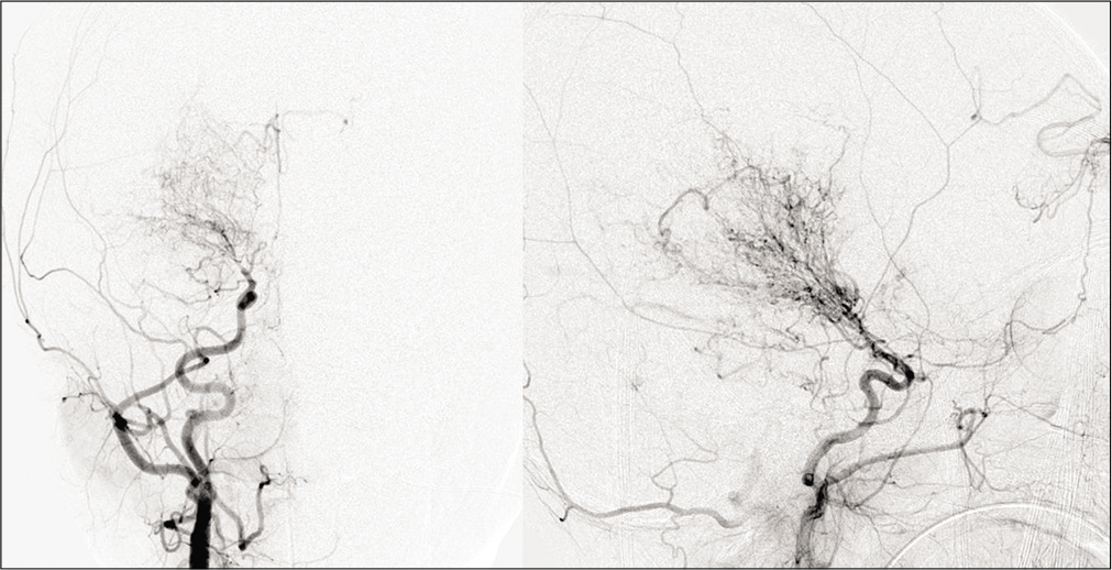 Moyamoya in a 28-year-old male patient with sickle cell disease. Frontal view of the conventional angiogram of the head shows severe narrowing of the right internal carotid artery (arrowhead) with puff of smoke (arrow) due to lenticulostriate collaterals. Multiple extracranial, transdural, and intracranial (curved arrows) collaterals are seen on the surface of the brain.