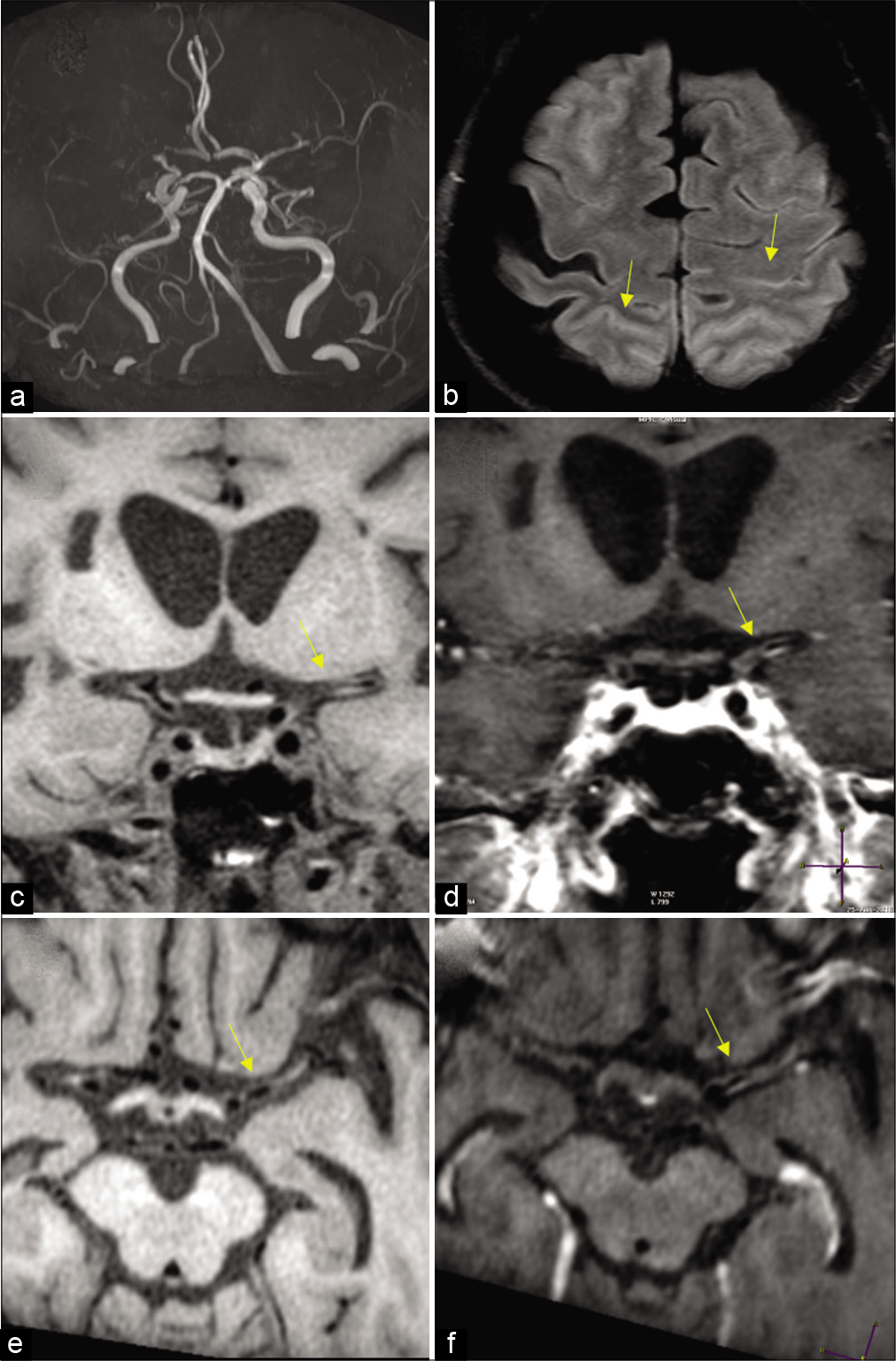 Moyamoya in a 27-year-old female patient with sickle cell disease. (a) Frontal view of the conventional angiogram of the head shows severe narrowing of the carotid terminus, more prominent on the right. (b) Axial FLAIR image reveals bright signal within the sulcal vessels suggesting collateral flow (ivy sign: Yellow arrows). Coronal (c,d) and axial (e,f) vessel wall images show concentric wall thickening of bilateral carotid terminus and left proximal MCA. Wall enhancement along on the left MCA (yellow arrows).