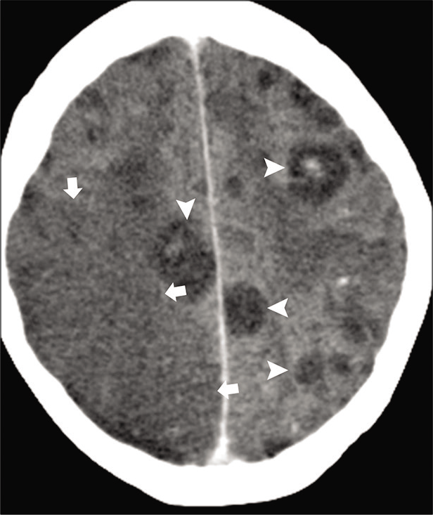 Acute infarction in a 36-year-old immunocompromised patient with aspergillosis. Axial contrast-enhanced CT images show multiple hypodense granulomas (arrowheads). Wedge shape hypodensity is seen in the right parietal lobe (arrows) consistent with acute infarction due to fungal vasculitis.