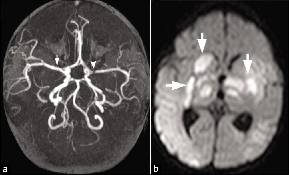 A 2-year-old child with bacterial meningitis presented with acute weakness and involuntary movements. (a) Maximum intensity projection from time-of-flight head MRA shows severe narrowing of the left M1 segment (arrowhead) and mild spasm of the right M1 segment (arrow) of MCAs. (b) Axial DWI image shows infarctions (arrows) in the bilateral deep gray matter nuclei and thalami secondary to infective vasculitis and spasm.