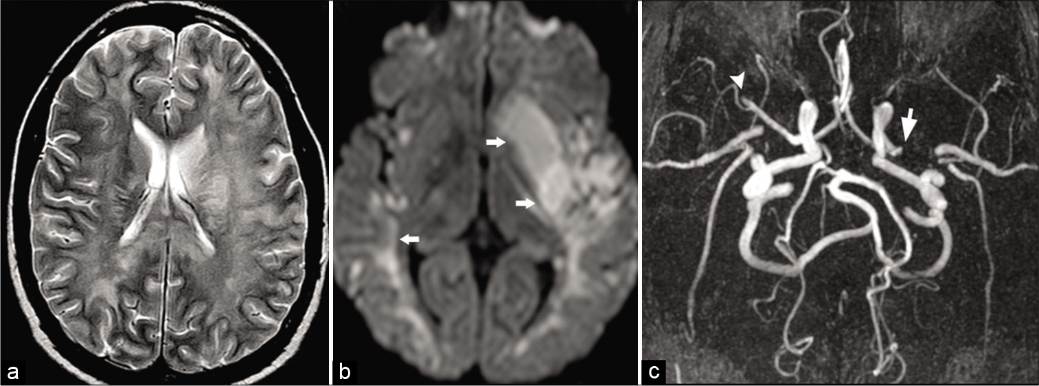 Cocaine vasculitis. A 31-year-old male patient presented to ER with acute-onset right-sided weakness. (a) Axial T2 image shows diffuse white matter hyperintensity due to vasculopathic changes. (b) Axial DWI image shows acute infarction (arrows) involving the left putamen and bilateral temporal lobe. (c) Time-of-flight MRA maximum intensity projection (MIP) shows acute cutoff of the left (arrow) and right (arrowhead) MCAs.