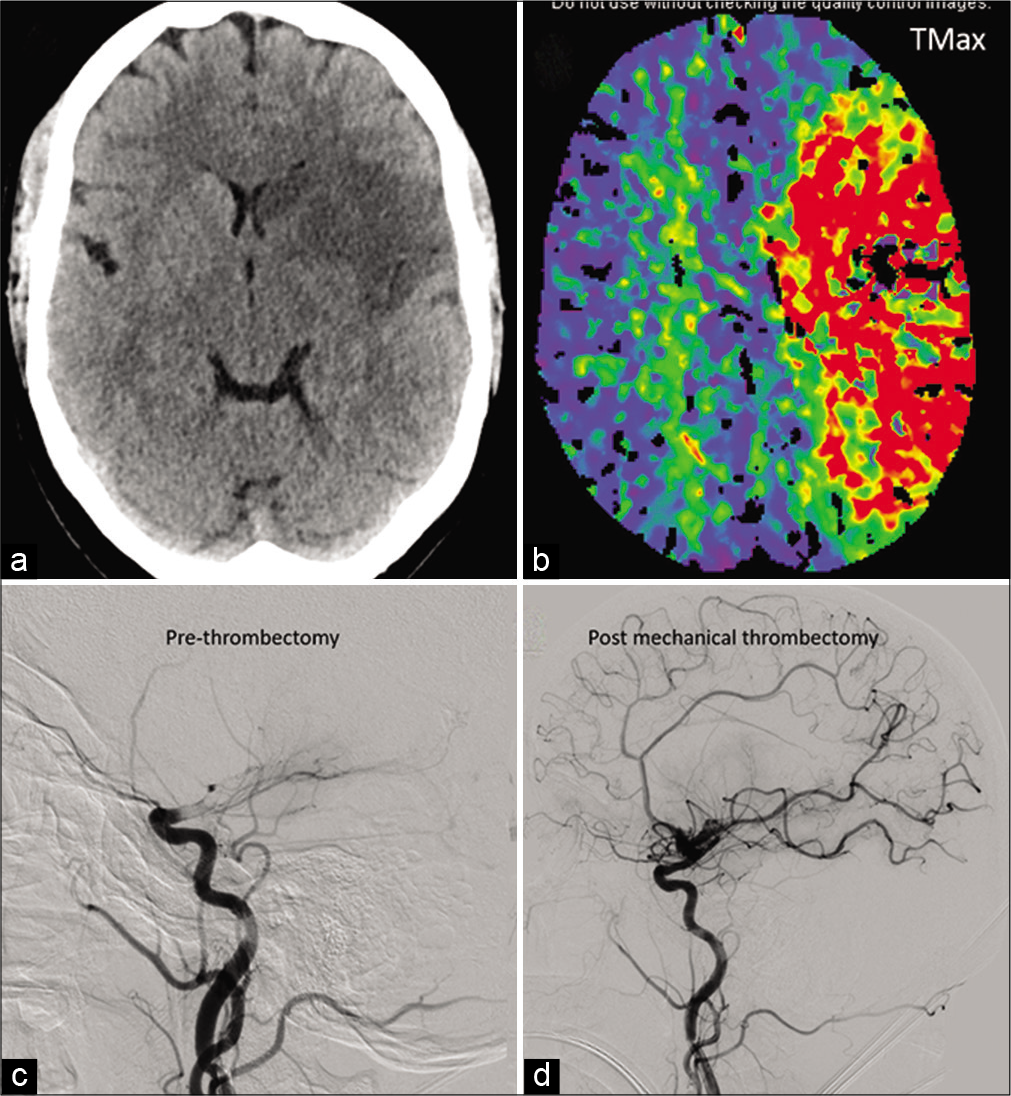 A 41-year-old COVID-positive patient with ischemic stroke secondary to large vessel occlusion: Moderate size acute infarct in the left MCA territory on non-contrast head CT (a). Large ischemic penumbra noted on the Tmax perfusion maps involving the entire left MCA territory (b). Catheter angiogram shows complete occlusion beyond the carotid terminus (c) with significant revascularization post-thrombectomy (d).