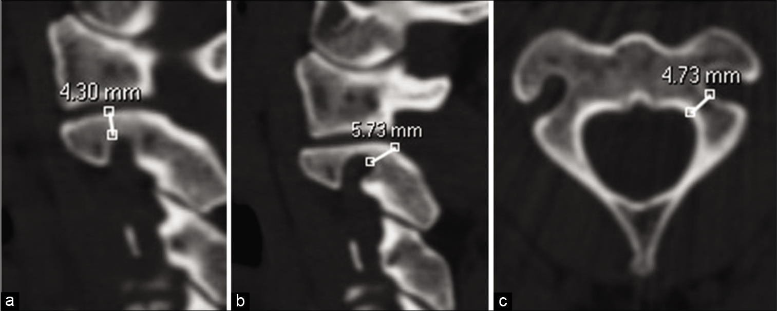 The isthmus height and the internal height of C2 of a 39-year-old male. A sagittal reformation slice (a) shows the internal height of lateral mass and (b) the isthmus height of the C2. An axial slice (c) shows the width of C2 pedicle.