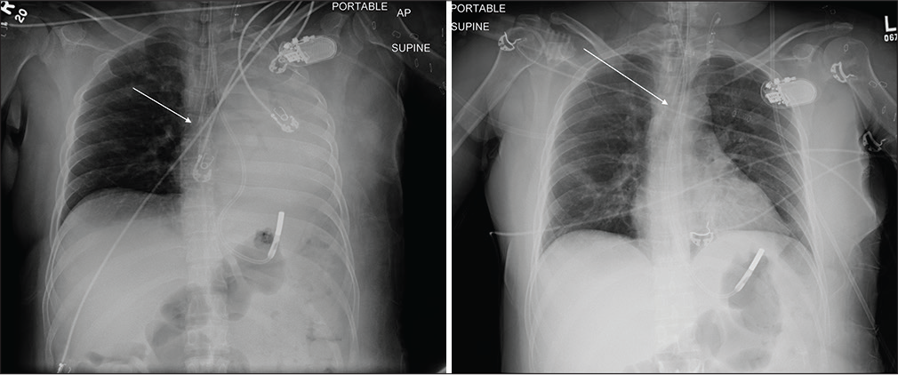 A 55-year-old male with nephrotic syndrome developed dyspnea. (a) Portable chest radiograph reveals right main stem bronchus intubation (white arrow) with associated complete collapse of the left lung. (b) Repeat portable chest radiograph after repositioning the endotracheal tube with its tip now terminating 3 cm above the carina (white arrow) and resultant reexpansion of the left lung.