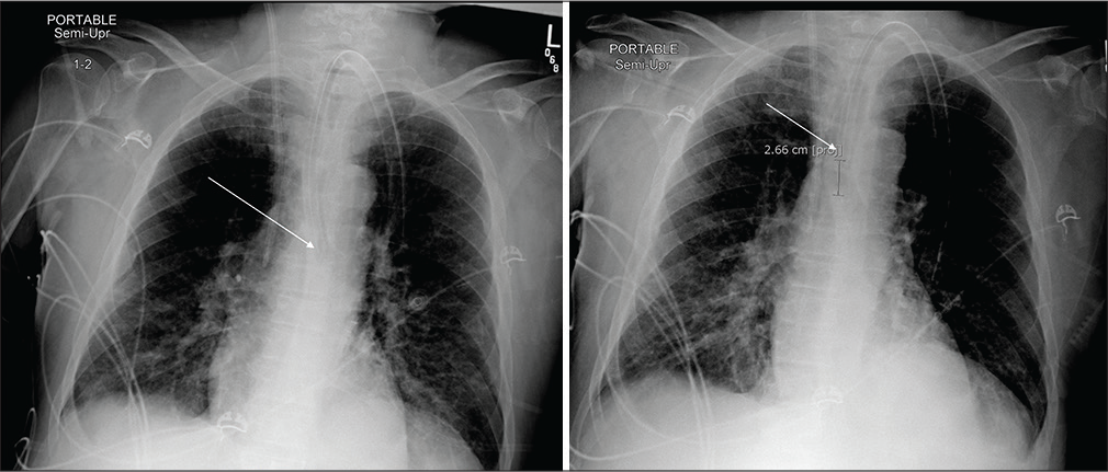 A 54-year-old male admitted in the ICU following a fire accident. (a) Portable chest radiograph reveals left main stem bronchus intubation (white arrow) with bilateral perihilar opacities suggestive of inhalational pneumonitis. (b) Repeat portable chest radiograph after repositioning the endotracheal tip now terminating 2.7 cm above the carina (white arrow).