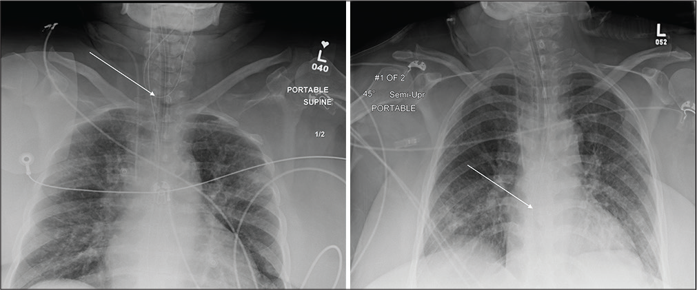 A 45-year-old female admitted in ICU post-cholecystectomy. (a) Portable chest radiograph reveals coiling of non-weighted enteric tube in neck (white arrow). (b) Repeat portable chest radiograph after repositioning the enteric tube which now courses through the diaphragm with tip beyond the field of view (white arrow) and mid background pulmonary edema.