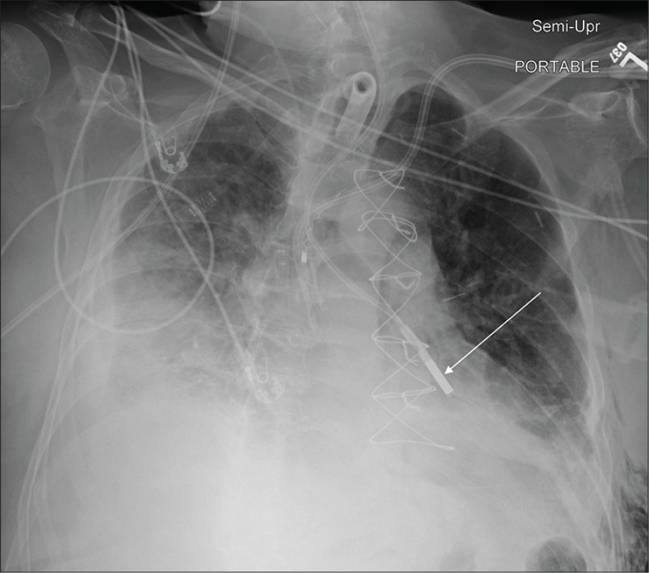 A 43-year-old male post-thymic resection admitted in the ICU. Portable chest radiograph reveals moderate right pleural effusion with adjacent atelectasis, tracheostomy, and appropriately positioned bilateral central venous catheters. The weighted enteric tube coursing into the left main stem bronchus (white arrow).