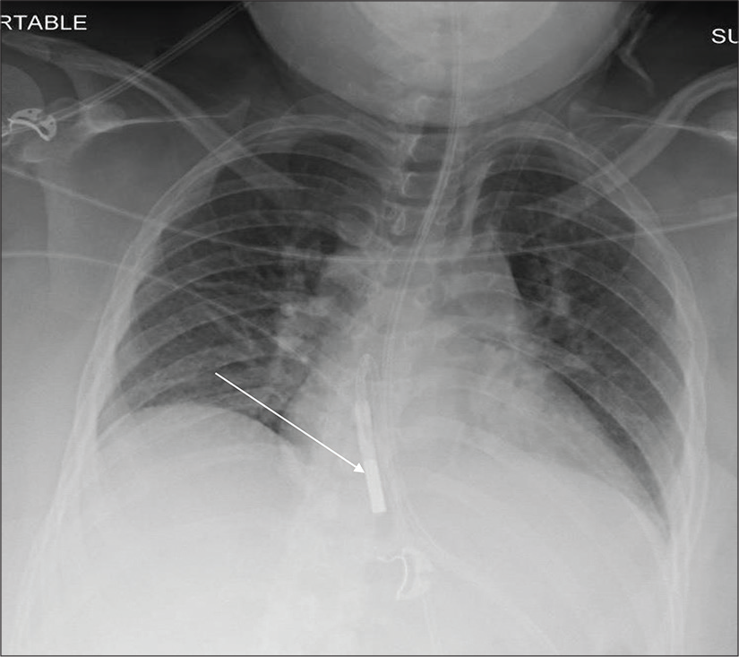 A 28-year-old male post-appendectomy admitted in ICU. Portable chest radiograph demonstrates hypoinflated lungs with bibasilar atelectasis and coiling of weighted enteric tube within the mid-thoracic esophagus (white arrow).