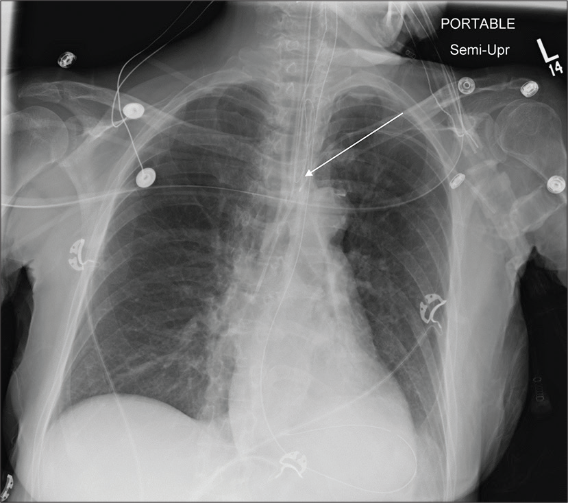 A 45-year-old female post-kidney transplant admitted in ICU. Portable chest radiograph reveals left retrocardiac atelectasis and coiling of esophageal temperature probe with its tip in the proximal thoracic esophagus (white arrow). Other support devices are appropriately positioned.