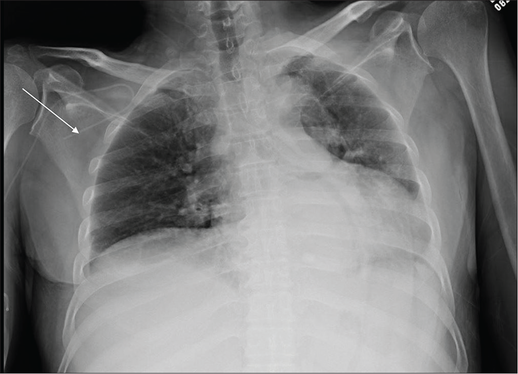 A 44-year-old male with renal failure admitted in ICU. Portable chest radiograph reveals hypoinflated lungs left retrocardiac atelectasis and coiling of the right subclavian approach central venous catheter and terminating in the right axillary artery (white arrow).