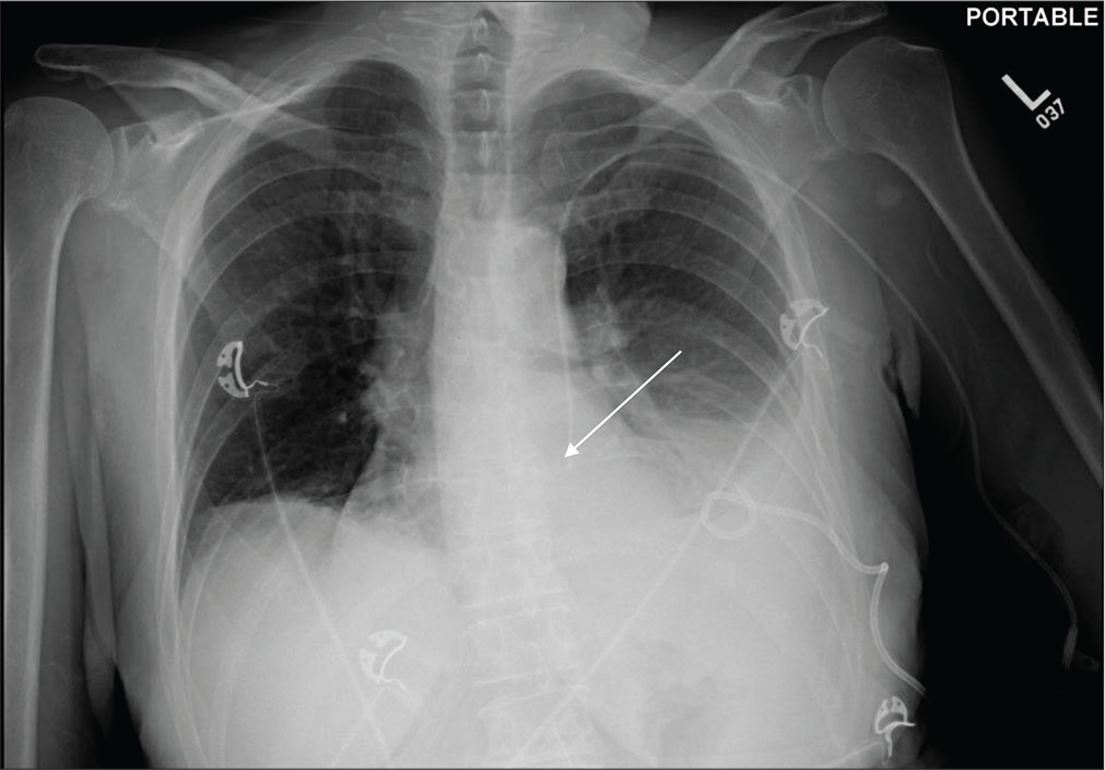 A 54-year-old female with ruptured splenic abscess admitted in the ICU. Portable chest radiograph reveals small left pleural effusion with the left basilar atelectasis and anomalous course of the left subclavian approach central venous catheter into right ventricle (white arrow). This patient had a left-sided SVC (normal variant).