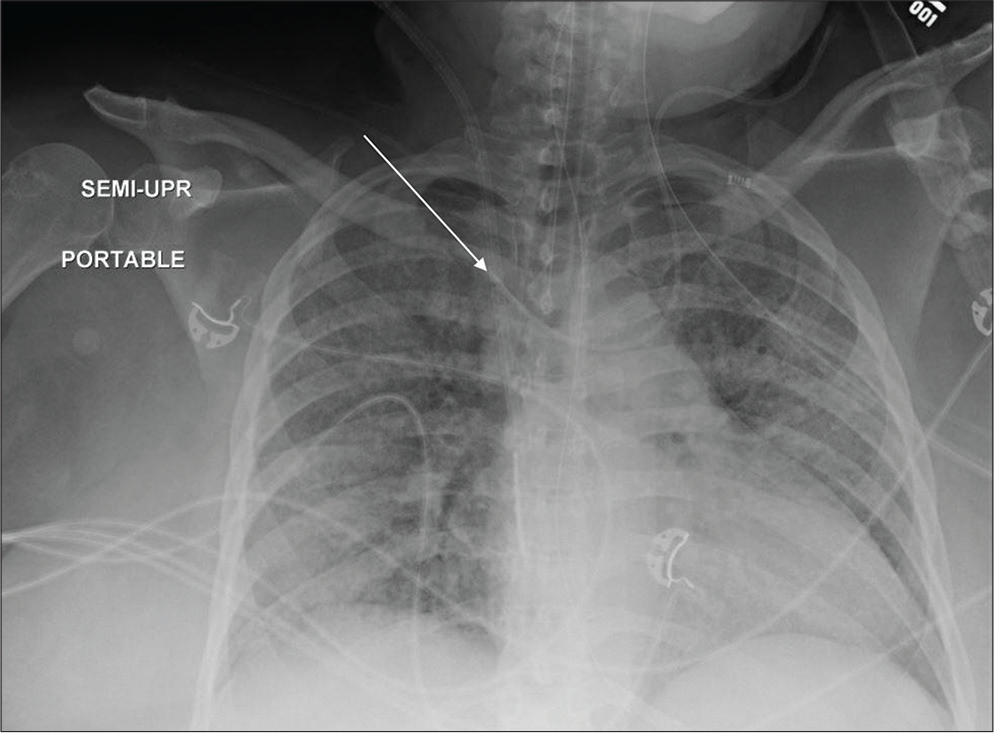 A 54-year-old male with congestive heart failure admitted in ICU. Portable chest radiograph reveals pulmonary edema and malpositioned left IJV approach central venous catheter with its tip terminating in the distal right brachiocephalic vein (white arrow). Other support devices are appropriately positioned.