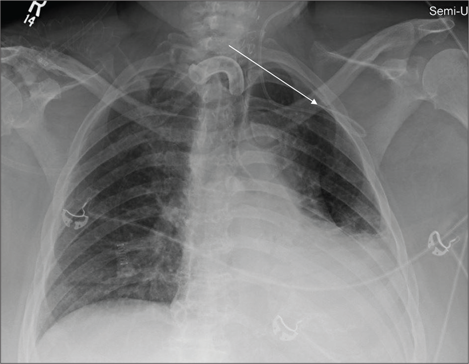 A 56-year-old male with laryngeal carcinoma admitted in ICU. Portable chest radiograph reveals tracheostomy tube within the tracheal air column, malpositioned left IJV approach central venous catheter coursing through and coiled within the left subclavian vein (white arrow), left pleural effusion, and adjacent atelectasis.