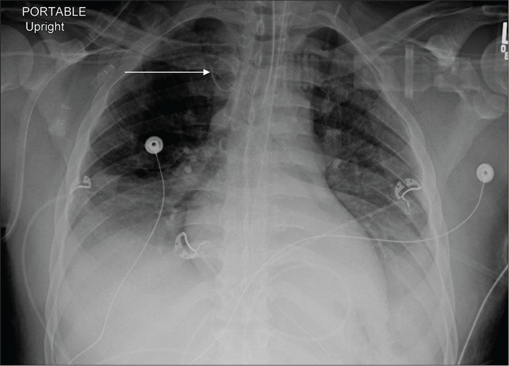 A 66-year-old male with pancreatic adenocarcinoma post Whipple’s procedure admitted in ICU. Portable chest radiograph reveals small bilateral pleural effusions and bibasilar and left retrocardiac atelectasis and coiling of the right subclavian approach central venous catheter in the proximal right brachiocephalic vein (white arrow). Other support devices are appropriately positioned.
